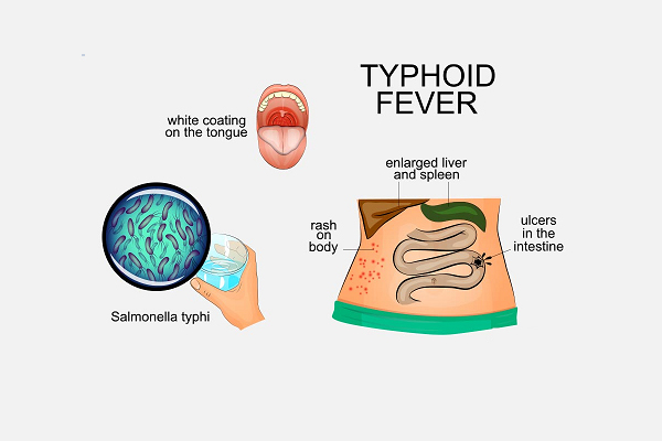 Typhoid Fever